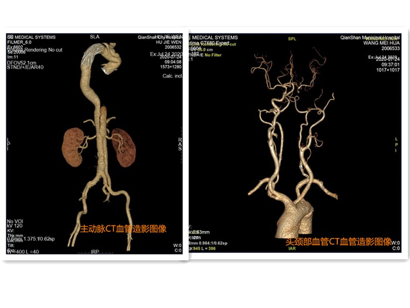 我院成功開(kāi)展頭頸部血管、主動(dòng)脈及肺動(dòng)脈CT血管造影檢查新項(xiàng)目
